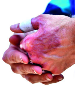 Burnt-left-hand-of-Romain-Grosjean
